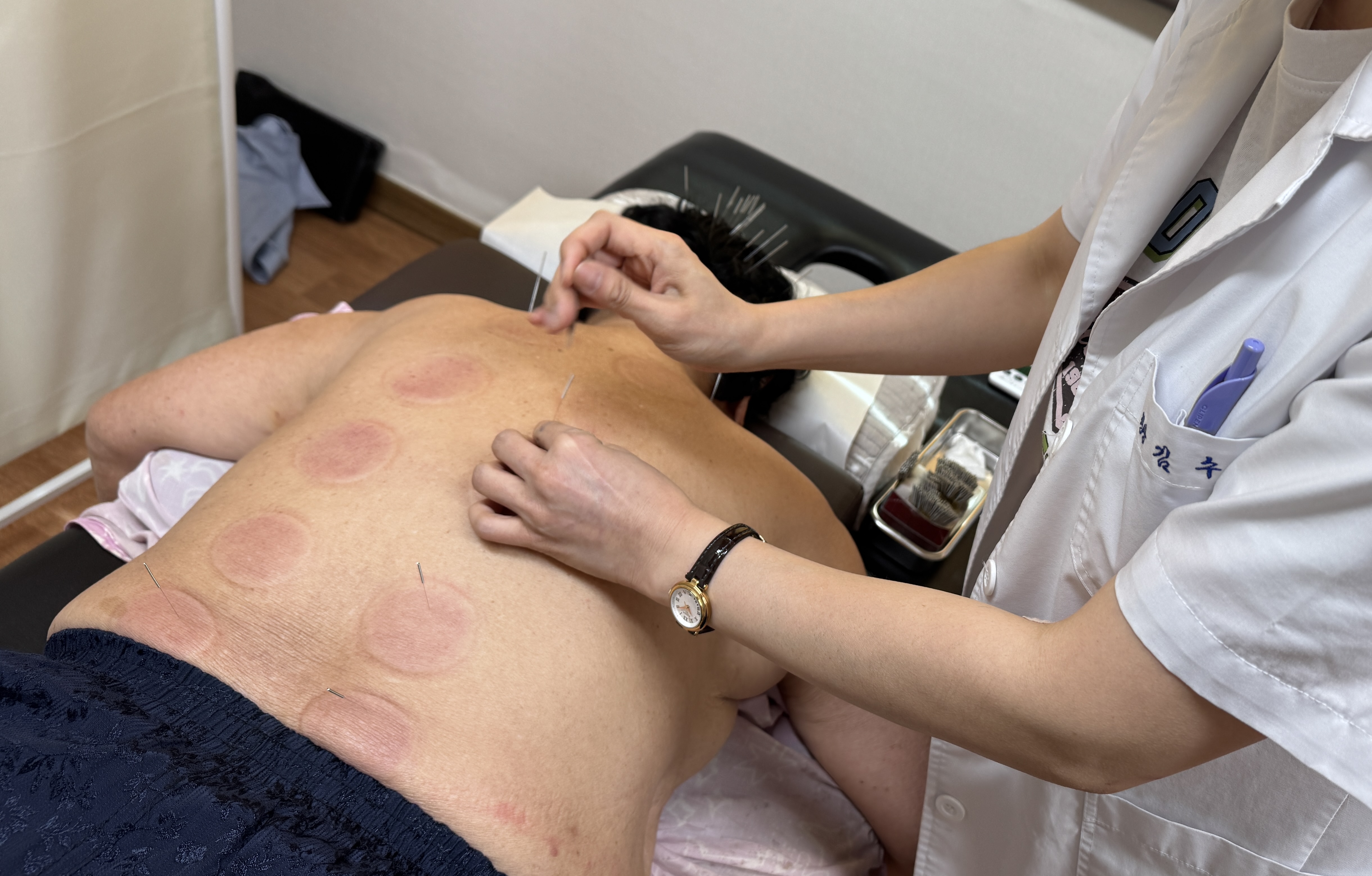 어르신의 등에 침과 부항이 함께 시술되는 장면