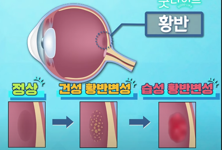 황반변성의 진행 과정