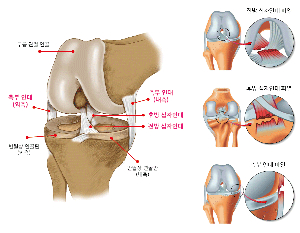 무릎십자인대파열