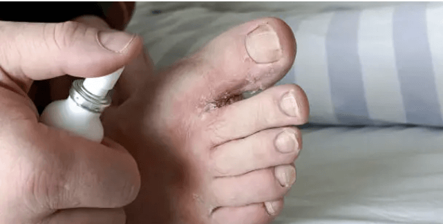 여름철 무좀 원인, 무좀 증상, 무좀 약 치료 방법 총정리