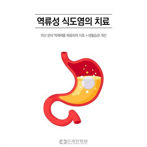 역류성식도염