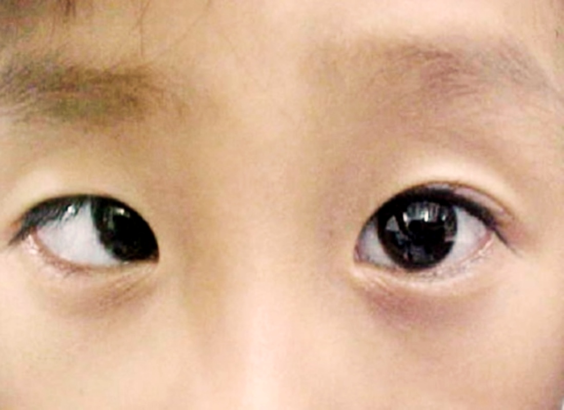 간헐적 외사시, 내사시, 상사시 사진