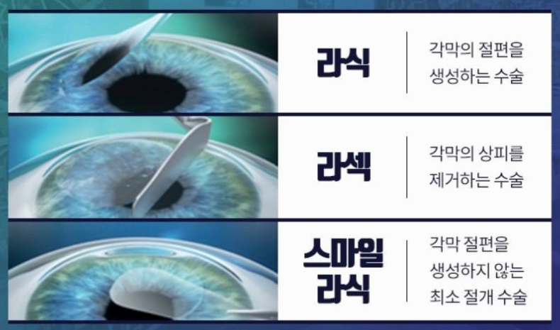 스마일라식 비용사진