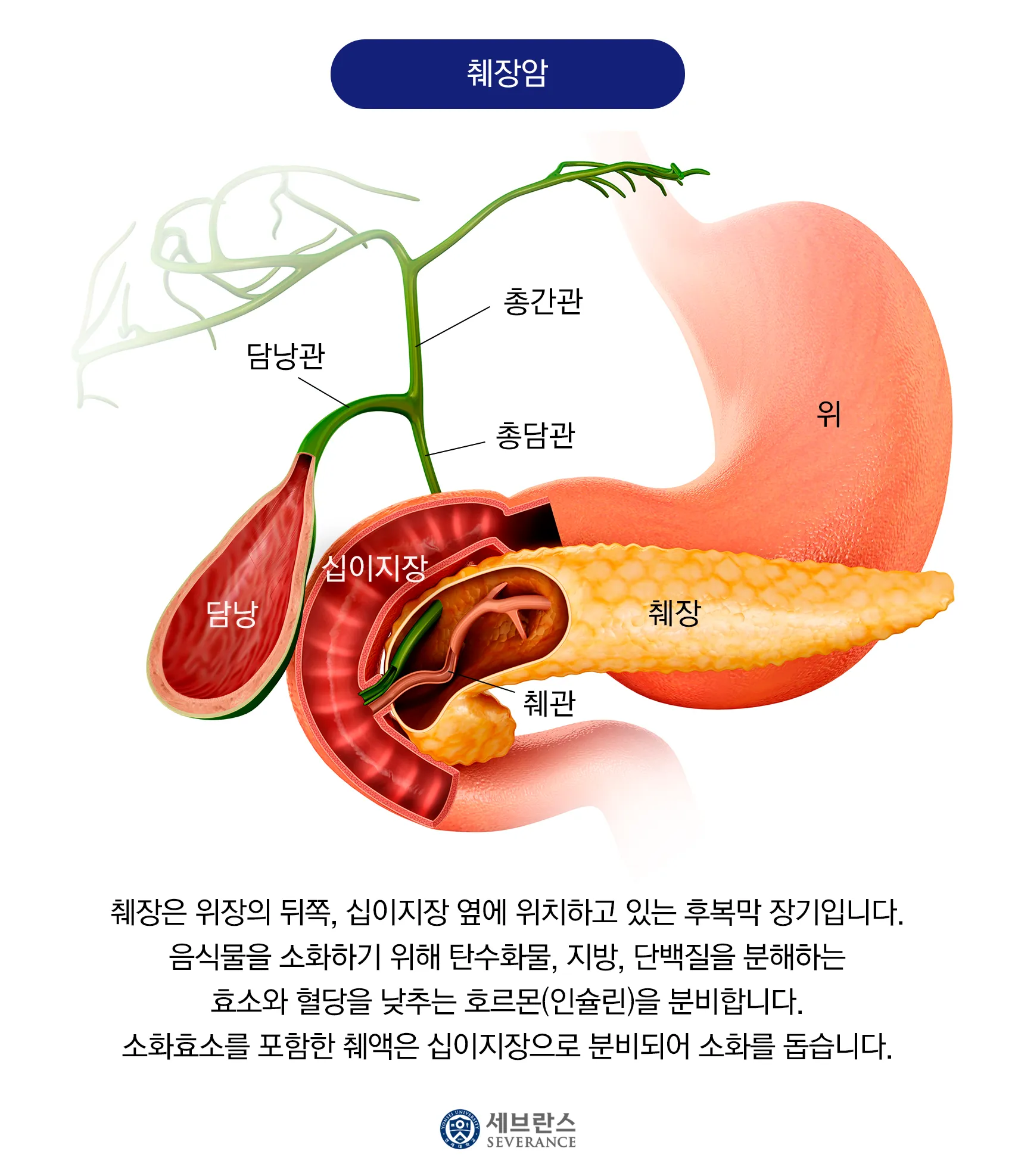 췌장암 초기 증상 췌장암 등통증 위치 검사_1
