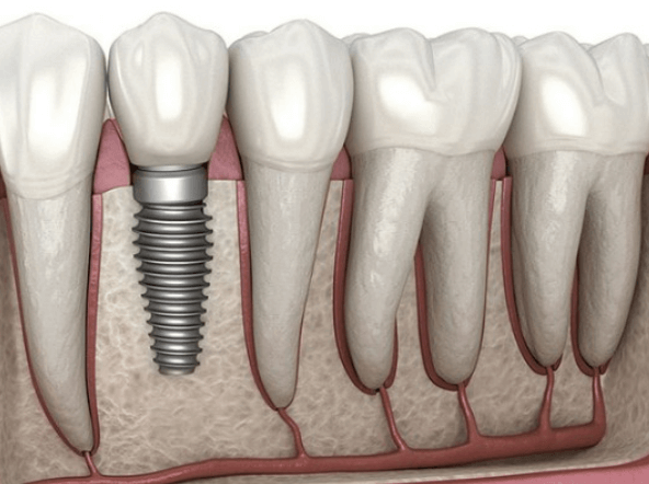 임플란트-주위염-치료하는-3가지-방법