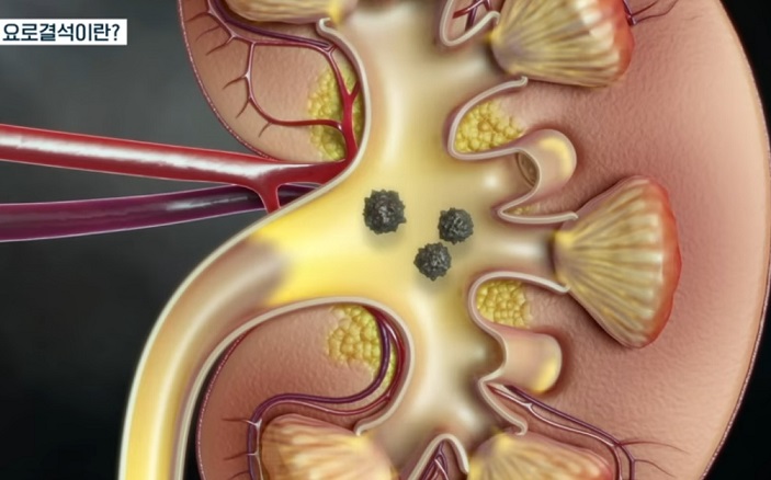 요로결석-명의-구교철-교수