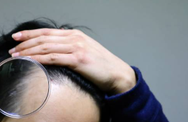 탈모
