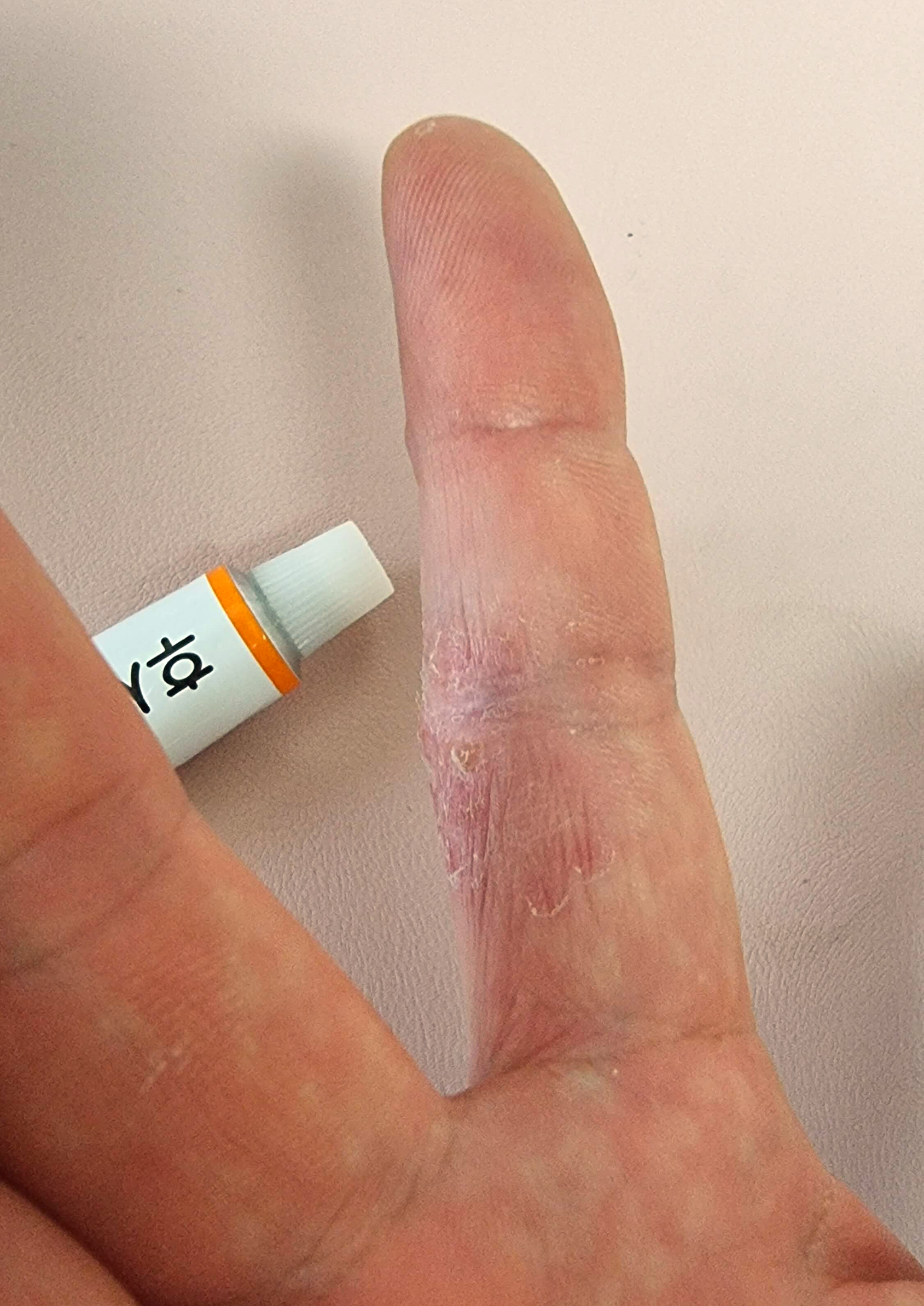 후시딘을 바른 후 손가락 주부습진