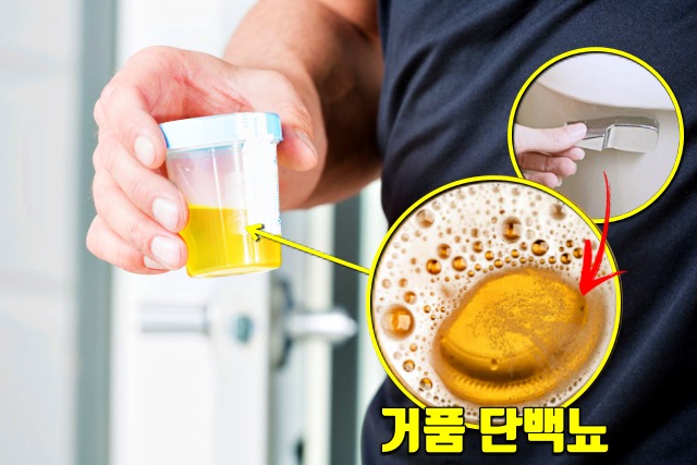 콩팥이 안좋을때 증상,소변 거품,콩팥이 안좋으면 나타나는 증상