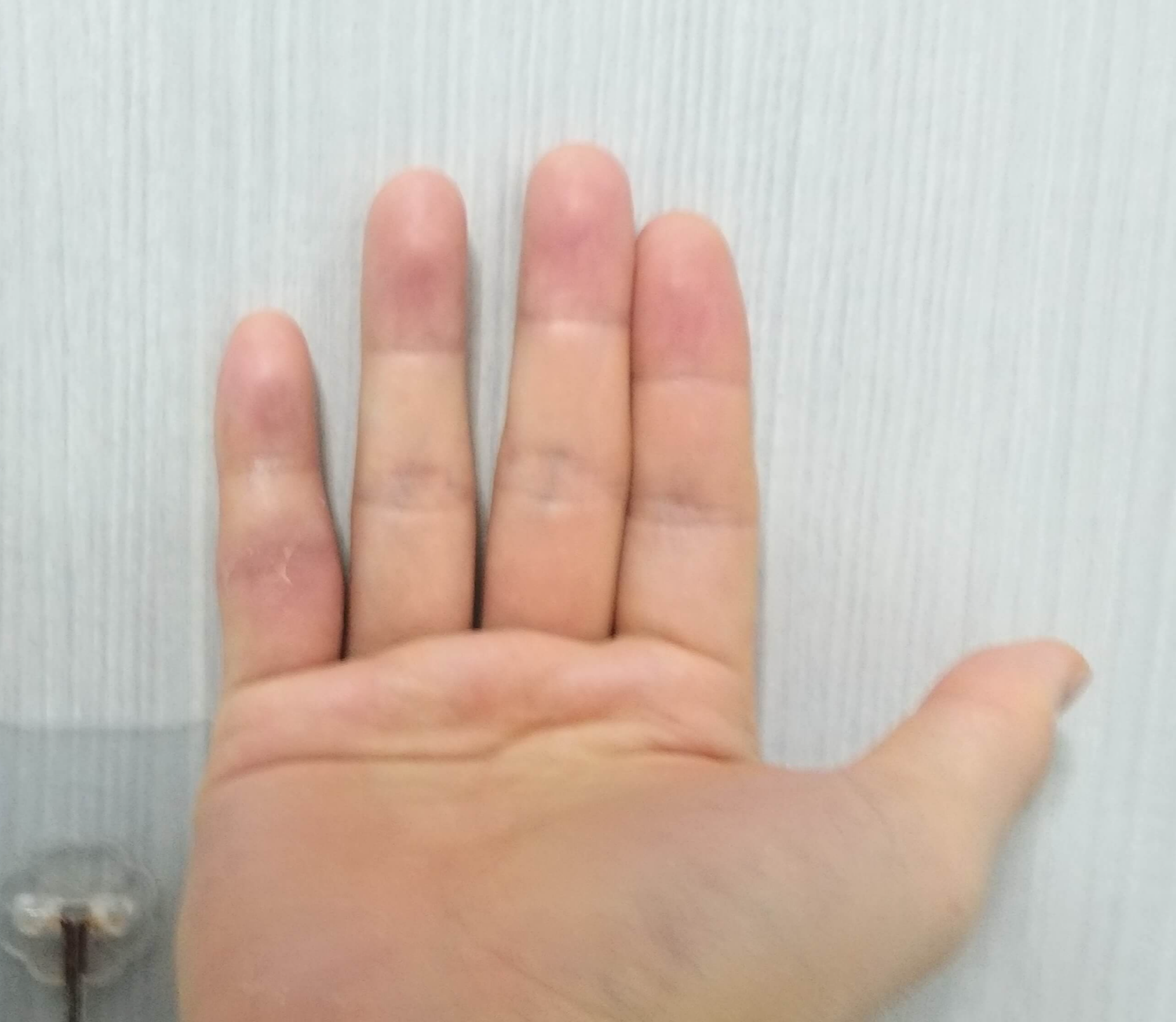 2월13일손가락상태사진1