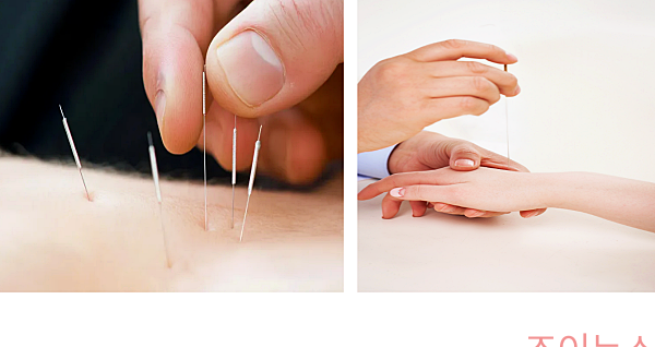 침 치료