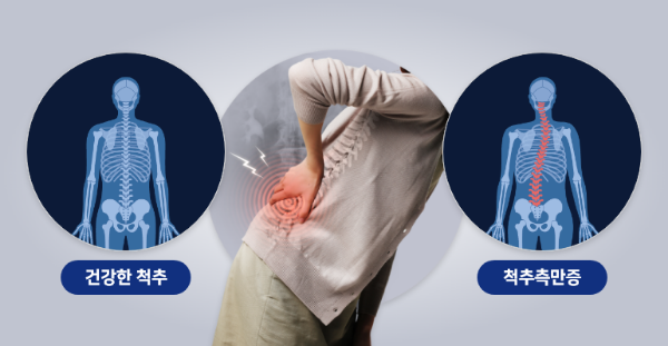 척추측만증의 원인