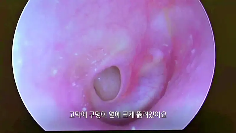 KBS 생로병사의 비밀 837회 난청도 재활이 필요, 돌발성 난청, 중이염, 이명 사례 보청기 인공와우 수술 진료 관련 오늘방송 다시보기 정보