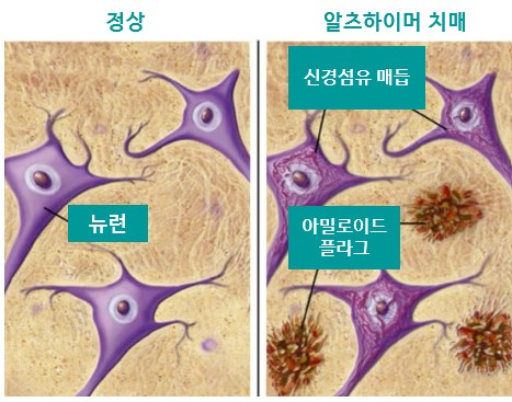 아밀로이드 플라크와 신경섬유 매듭 그림