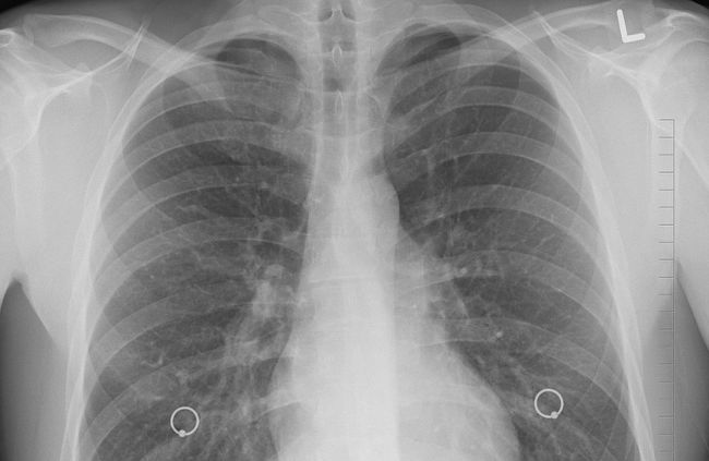 결핵 검사 방법