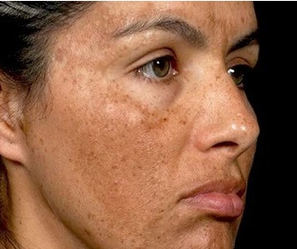 기미 잡티 제거