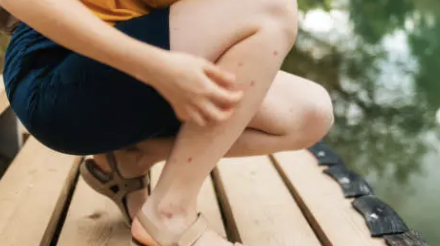 하지 정맥류 증상 13