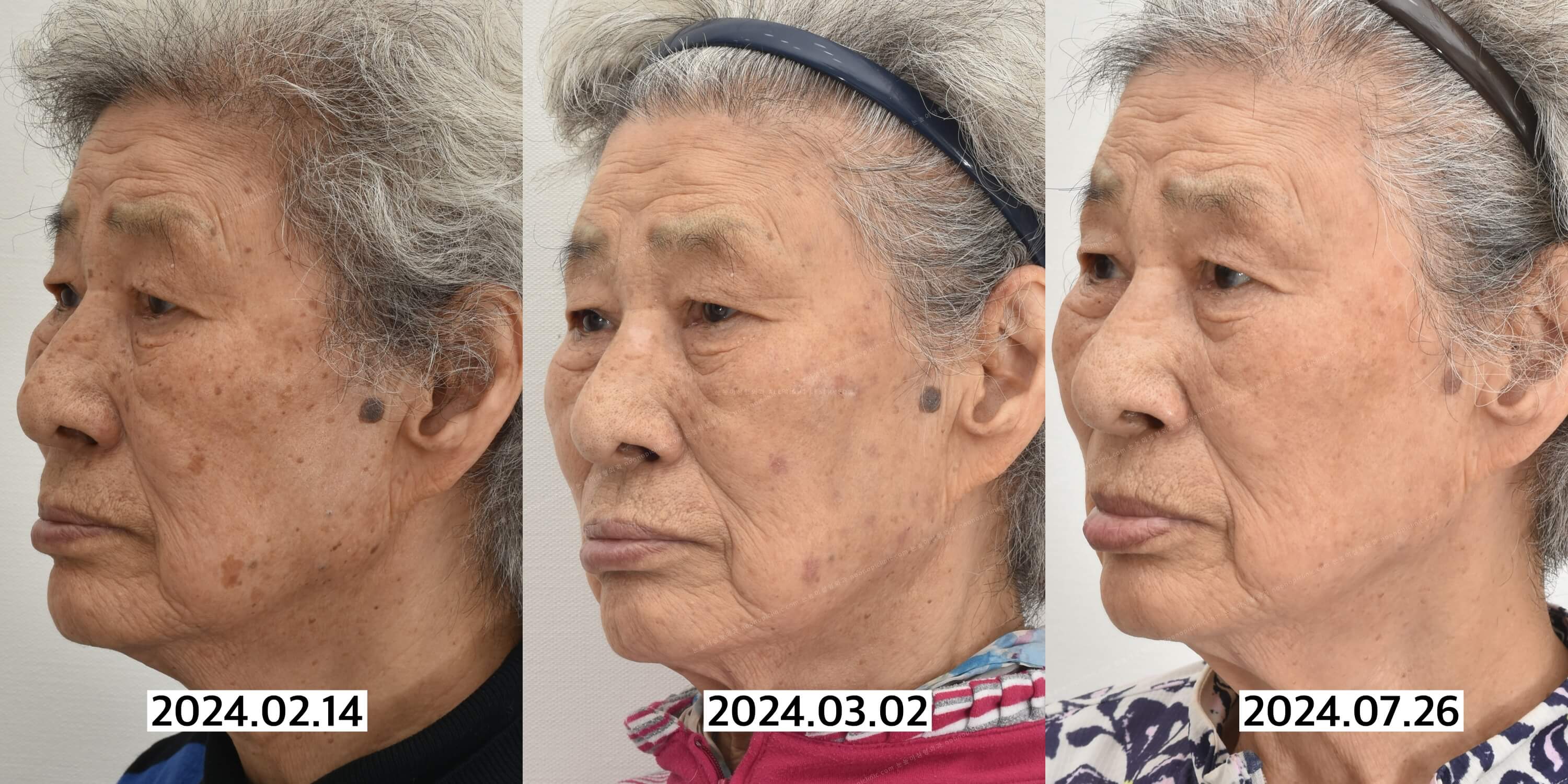검버섯없애는법