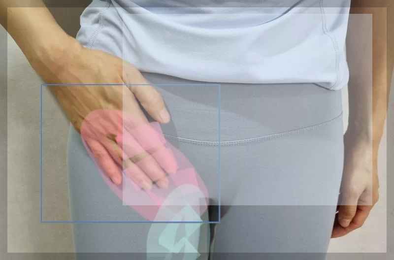 여성 사타구니 탈장