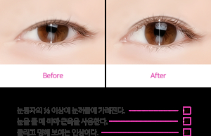 여자 무쌍 눈매 교정