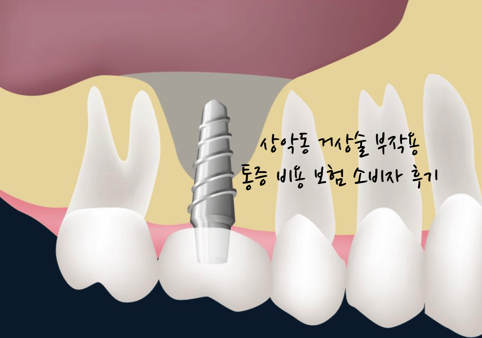 상악동 거상술