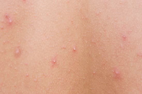 좁쌀여드름 ❘ 원인부터 치료, 관리법까지