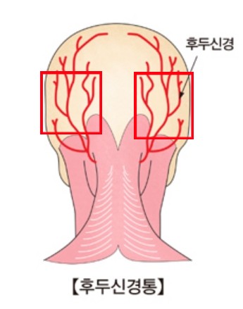 후두신경통