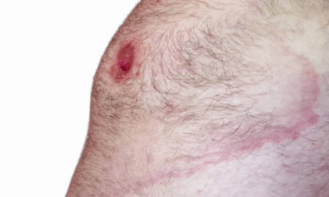 만성 피부염 치료