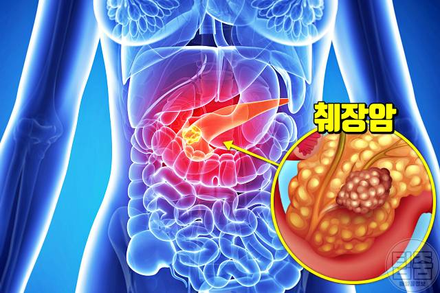 가슴통증 원인 증상 의심되는병 췌장암