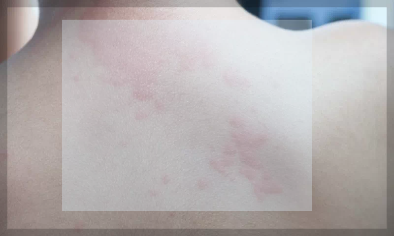 파종성 대상포진