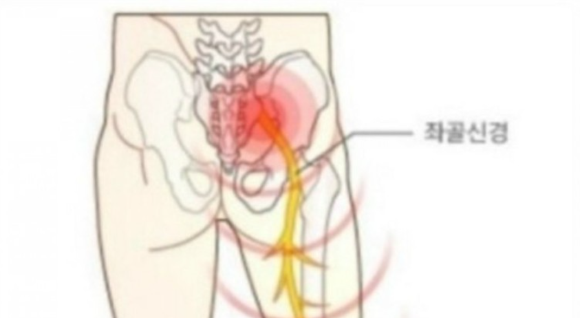 좌골신경통