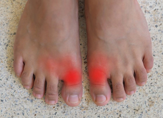 통풍 초기증상 3가지