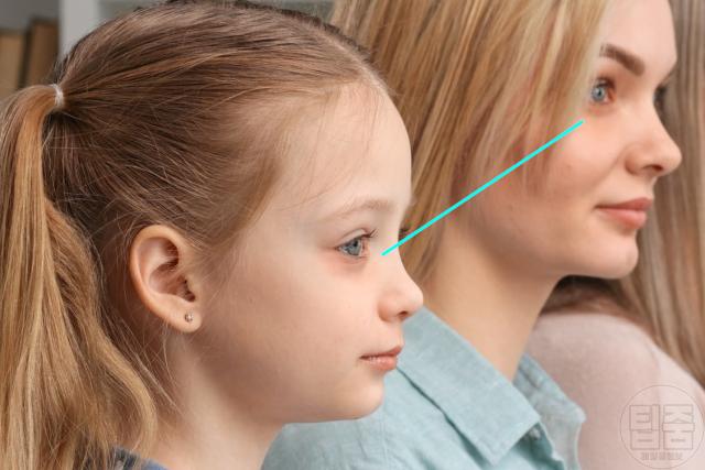 눈밑 지방 다크서클 원인 유전