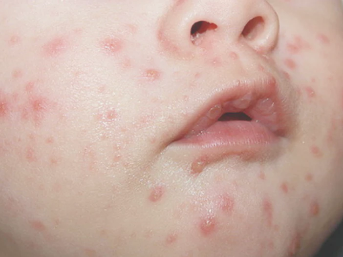 대상포진-초기증상-건강