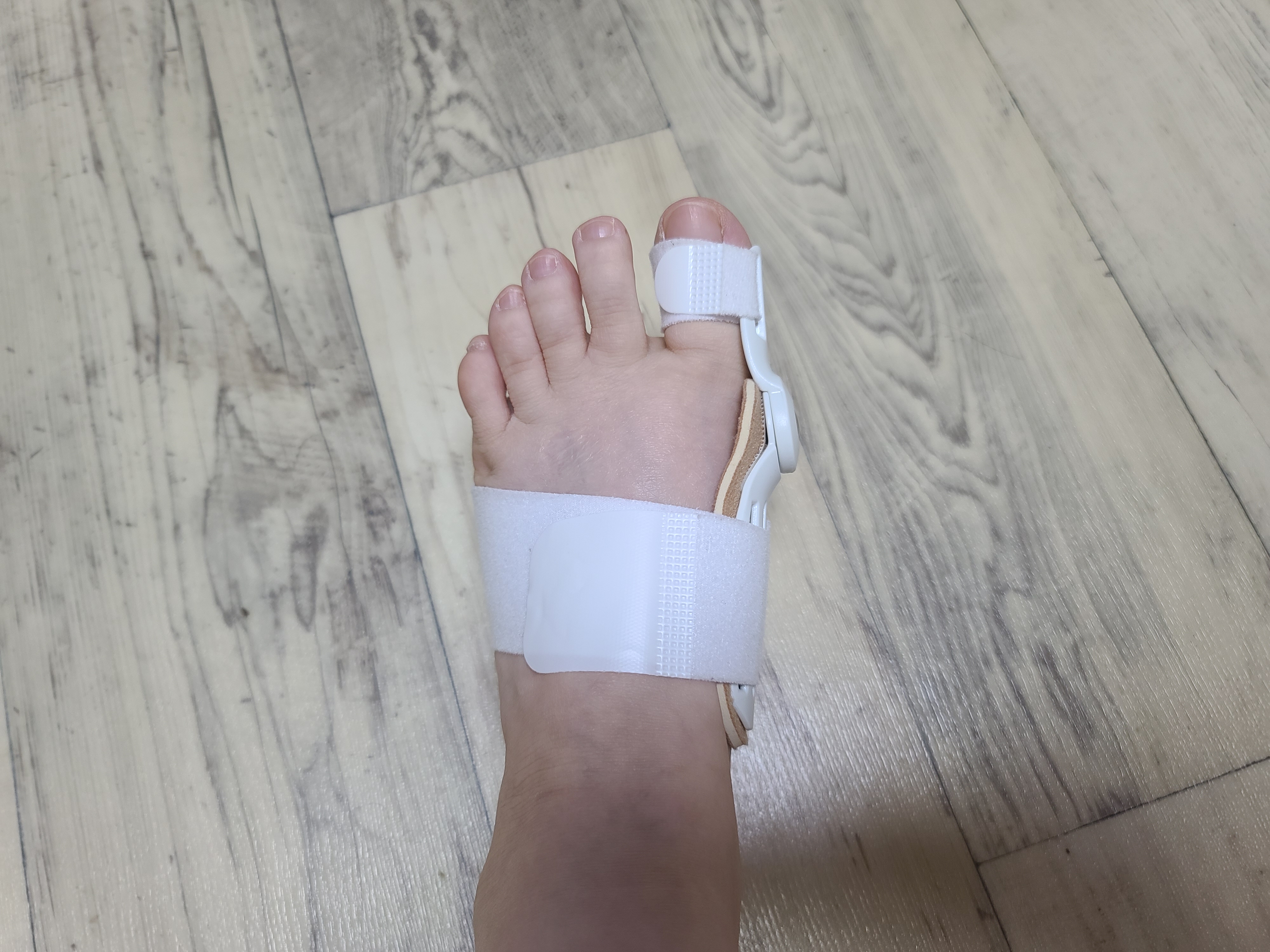 무지외반증 교정기