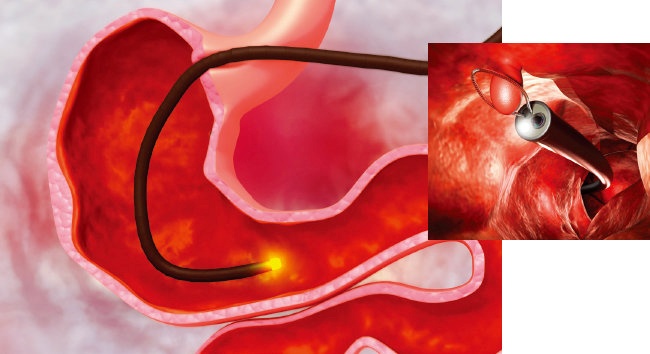 위궤양 치료방법