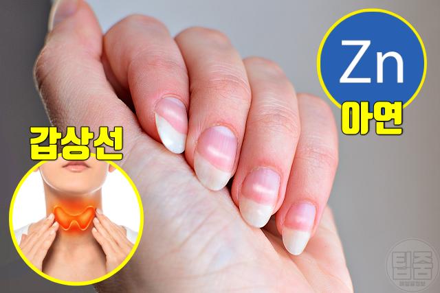 손톱 큐티클 흰점 아연 갑상선