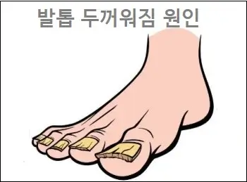 발톱 두꺼워짐 원인