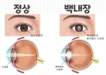 백내장 수술 비용 실비 보험 청구 회복기간_2