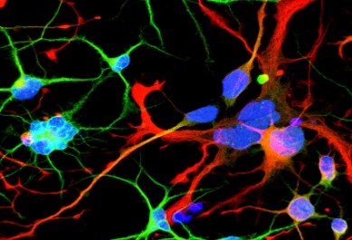 헌팅턴병 원인 증상 치료법