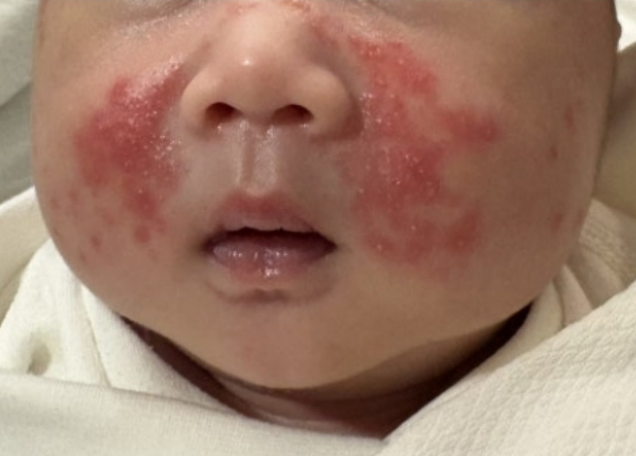 출생을 한 지 얼마 되지 않는 신생아의 얼굴에 태열로 인해서 얼굴의 볼 쪽이 울긋불긋하게 되고, 수포가 발생된 것을 찍은 사진