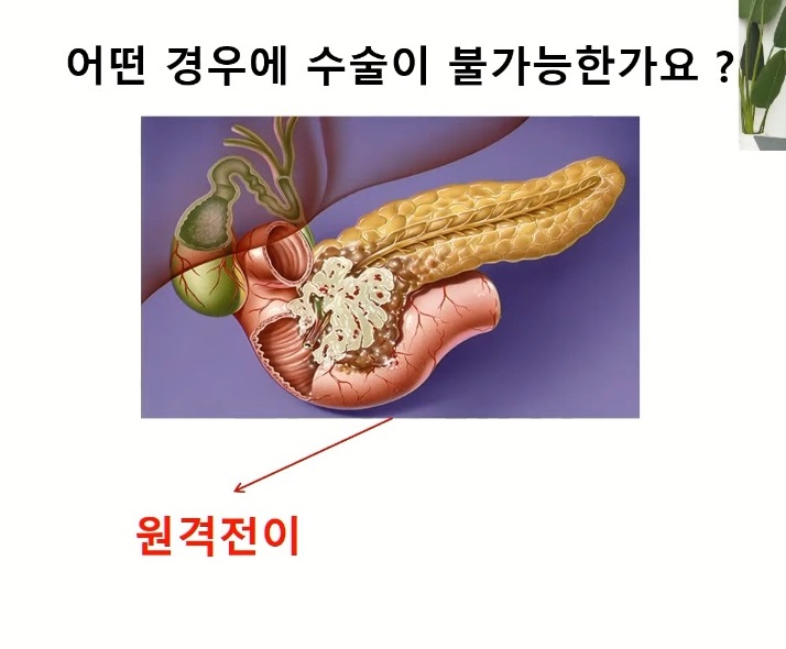 담석암명의-담낭암명의-방승민교수-황호경교수