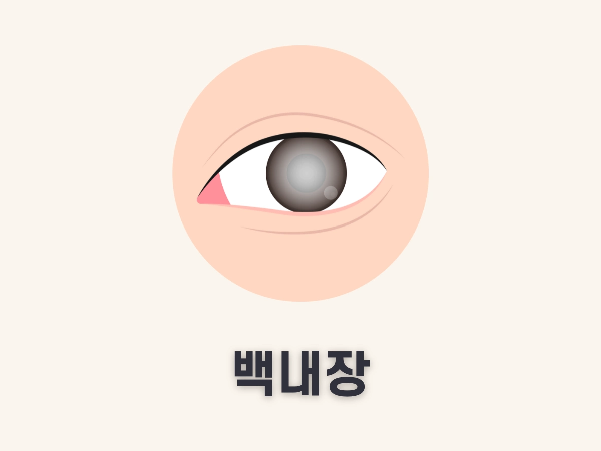 백내장