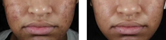 아클리프-크림으로-여드름-없애는-방법