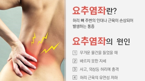 요추염좌(허리 염좌) 관련 이미지