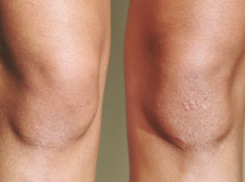 무릎 물 원인과 치료