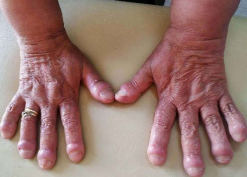 경피골막증 원인 분석 및 치료방법1