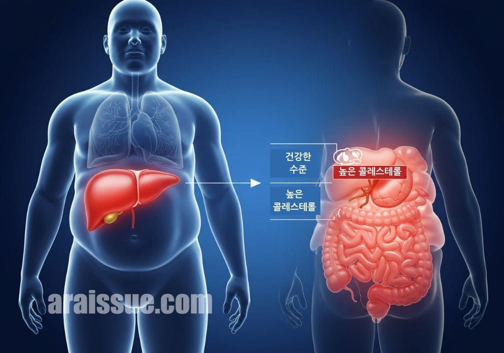 비만과 고지혈증, 지방간이 어떻게 연결되는지를 설명하는 이미지. 건강한 간과 지방이 쌓인 간을 대비해 보여주는 그림. 비만과 관련된 문제를 시각적으로 표현.