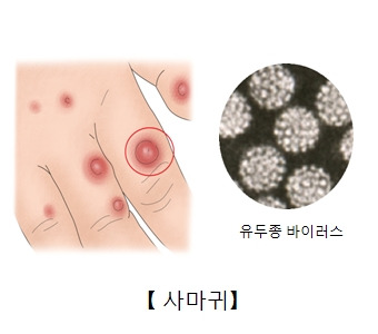 편평사마귀 증상, 원인, 치료