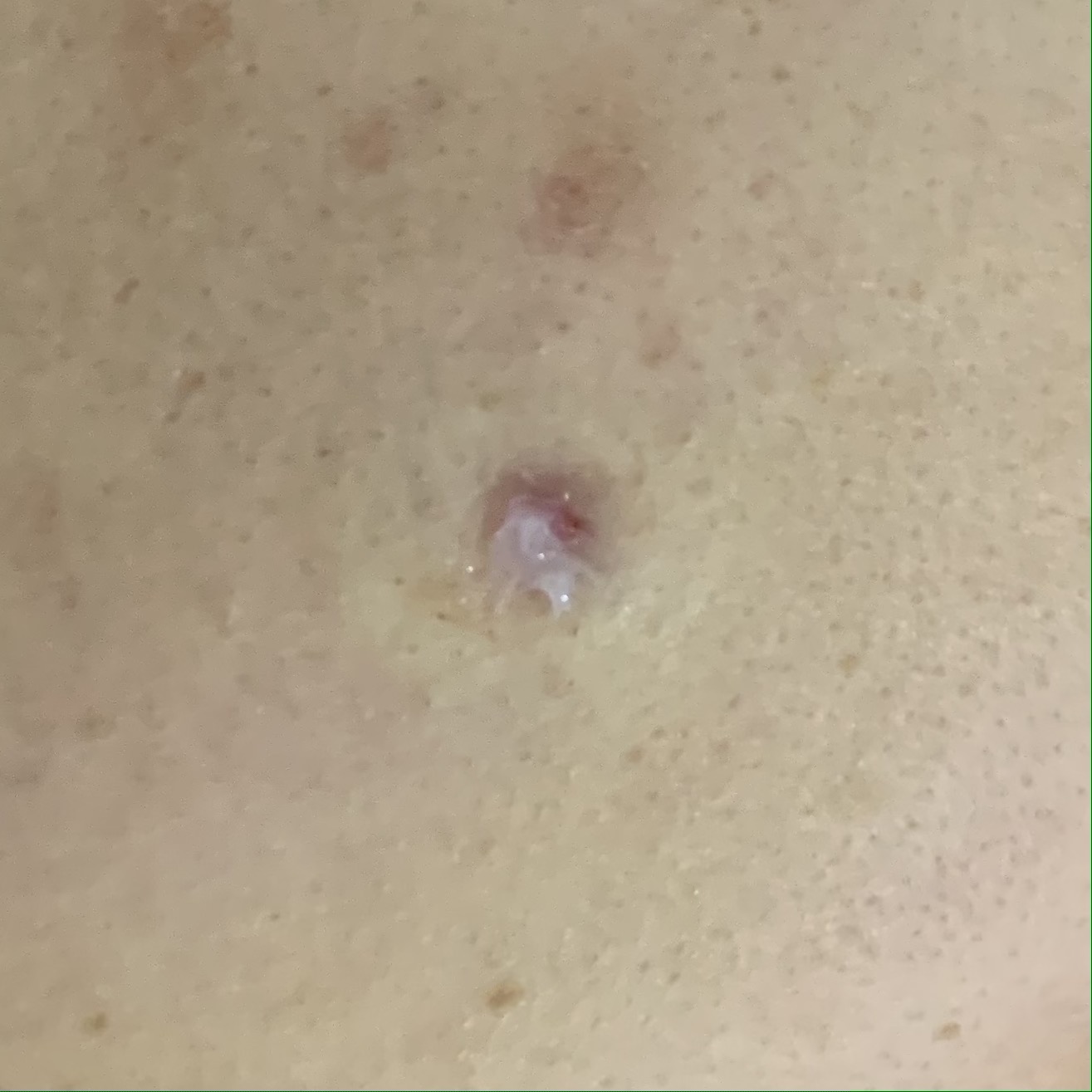 피지낭종 수술직후